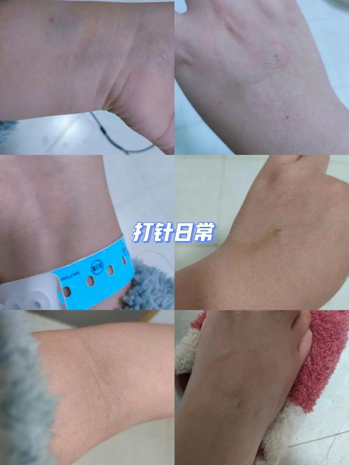 梦见打针抽血是什么意思？