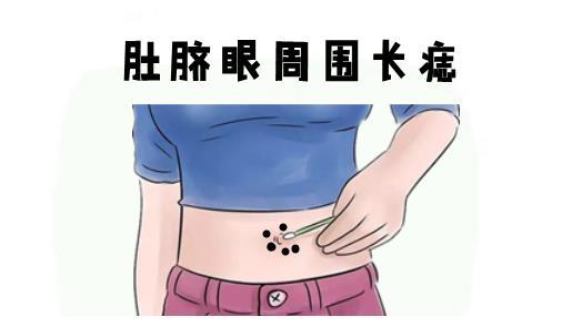 肚脐眼左边长痣好不好?可能会婚变!