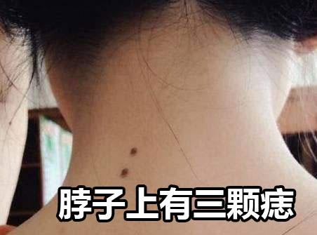 珍惜脖子上三痣