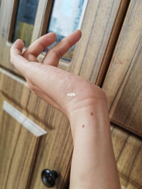 路旁土命人手上长痣运势如何
