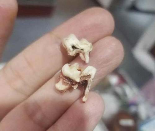 梦见牙掉光会不会有坏事发生