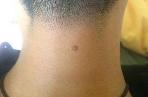 男人后脖子有痣好不好