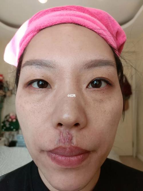 人中有疤痕的女人命运会如何?