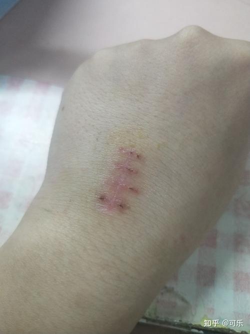 梦见自己手上的伤疤