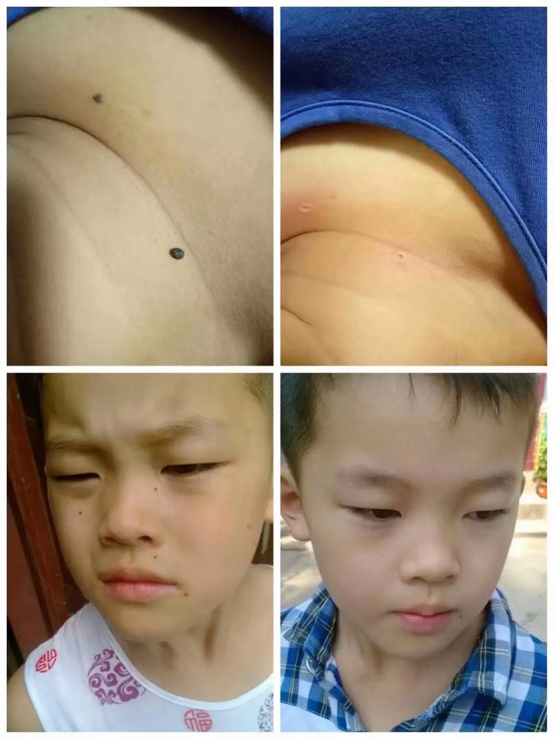 脸上哪些痣不能点掉图解,哪些是善痣