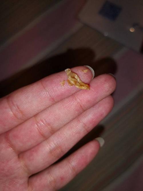 梦见挖耳屎挖出一大块