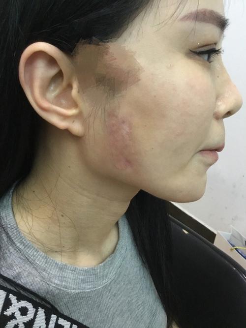 脸上这些地方有疤痕命中或有灾祸