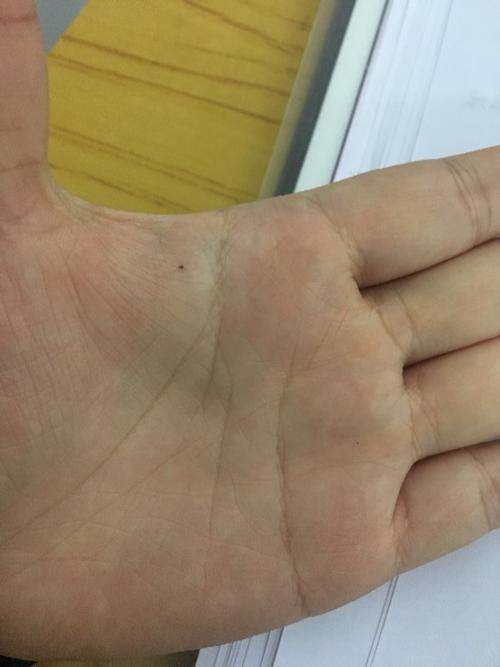 手掌边缘上突然长出了一颗痣