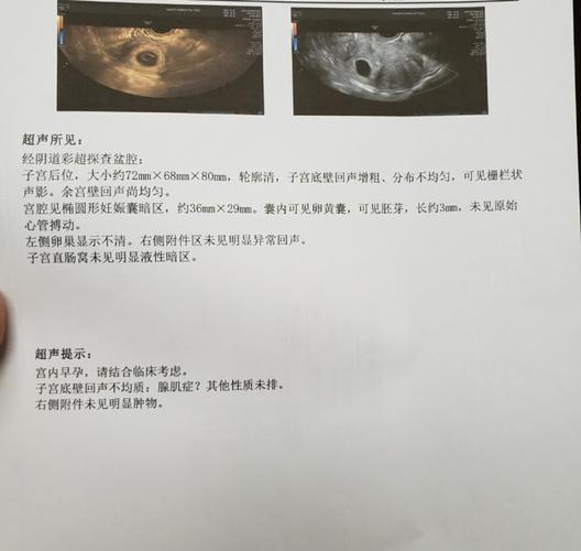 0型血怀孕容易胎停吗