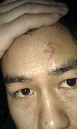 生男生女 脸上有疤容易生男孩还是女孩