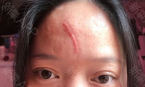 额头有疤痕是什么意思?