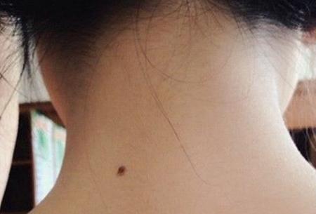 后颈椎上有痣的人命好吗