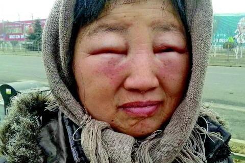 梦见眼肿是什么意思