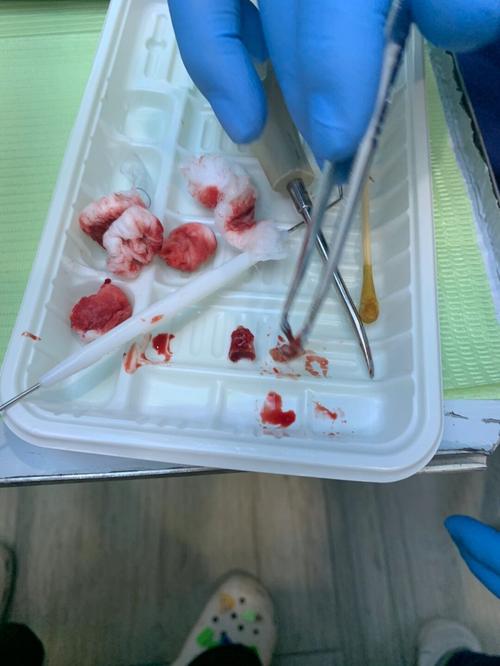 梦见自己用手拔掉蛀牙好吗