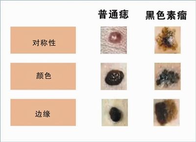 色素痣是什么？色素痣会癌变吗？