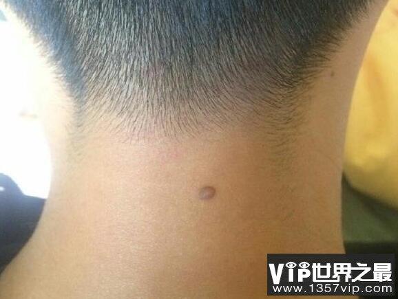后脖子有痣的男人好吗