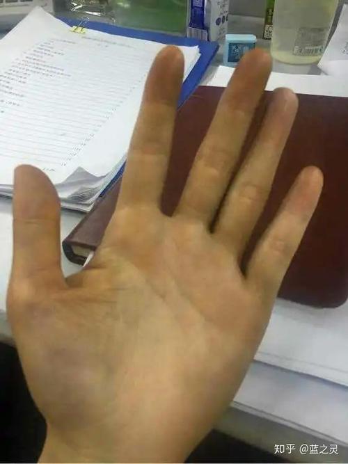 从手掌的异常感知健康状态