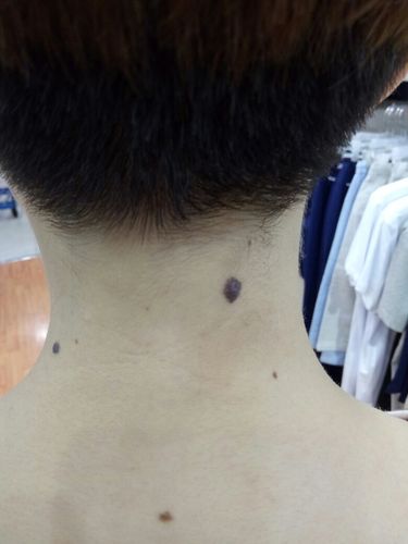 脖子后边长痦子代表什么