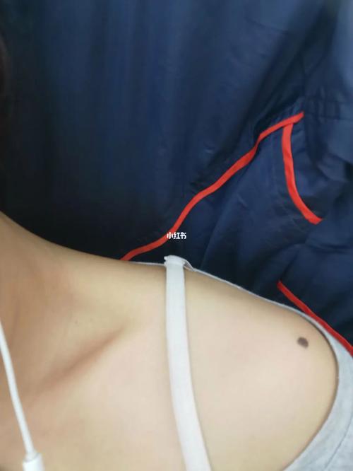 肩膀有痣说明什么问题