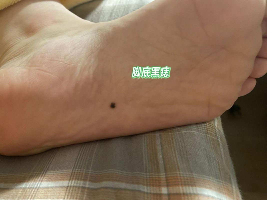 脚底长痣说明什么