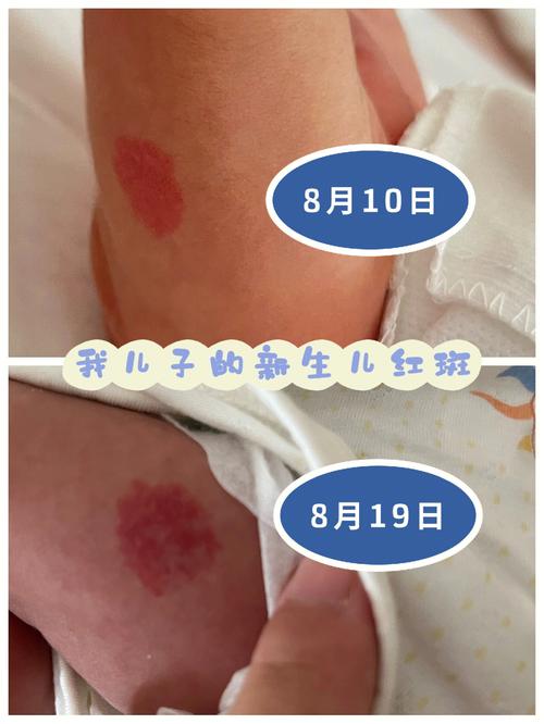 大腿上有胎记代表什么
