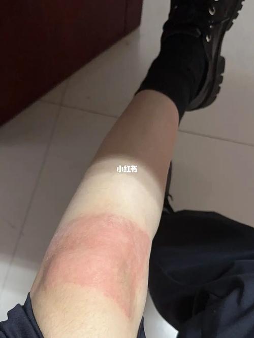 梦见自己过敏是什么意思