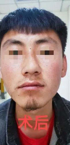 男人鼻子歪预示着什么,歪鼻子的男人真的不好
