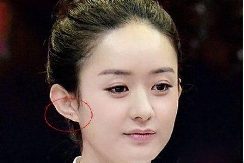侧脸靠近耳朵附近有痣