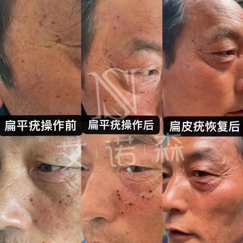 脸上的哪些痣代表好运不能去掉?