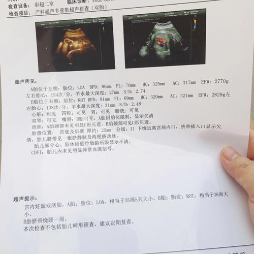 剖腹产选日子生孩子