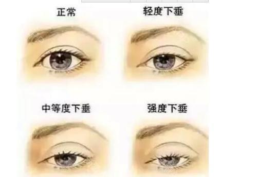 眼角下垂面相图片