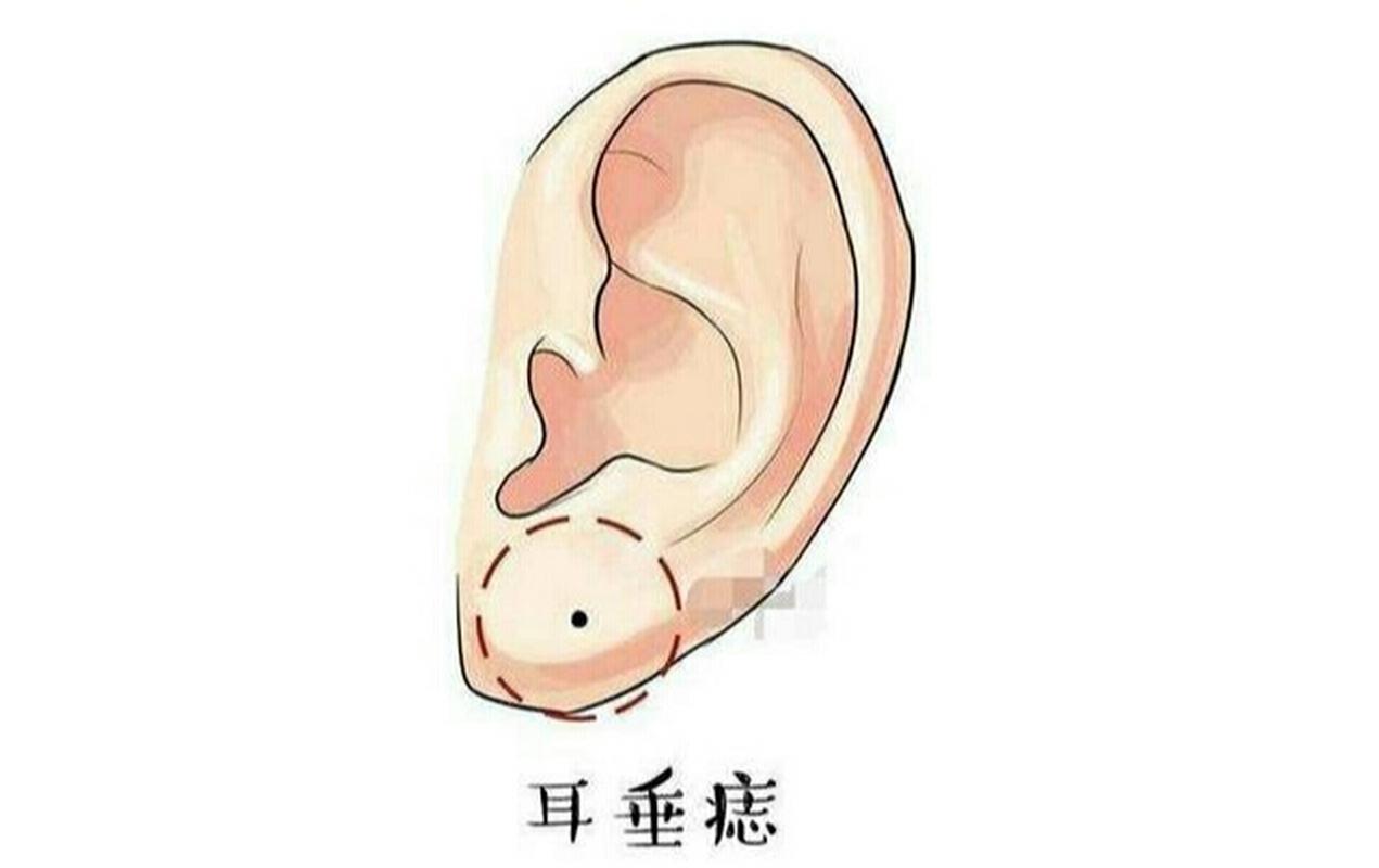 女人左耳垂有痣命好不好