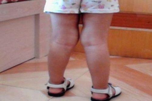 腿部畸形影响运势吗
