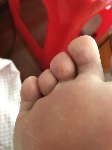 脚上有红色胎记对命运有什么影响?