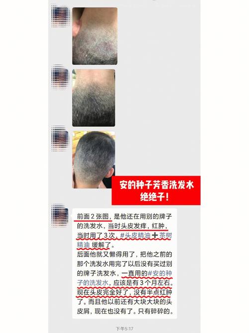 梦见头皮屑很多很大块是什么意思