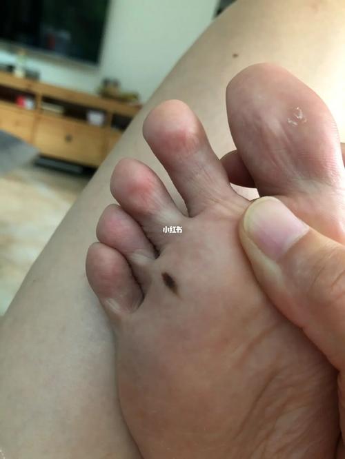 脚底三颗痣代表什么