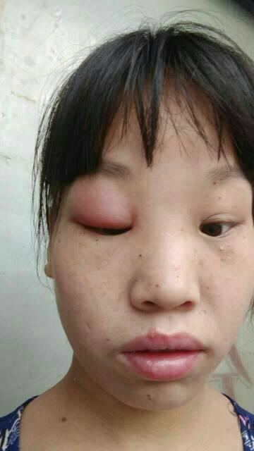 梦见自己眼睛肿了是什么意思