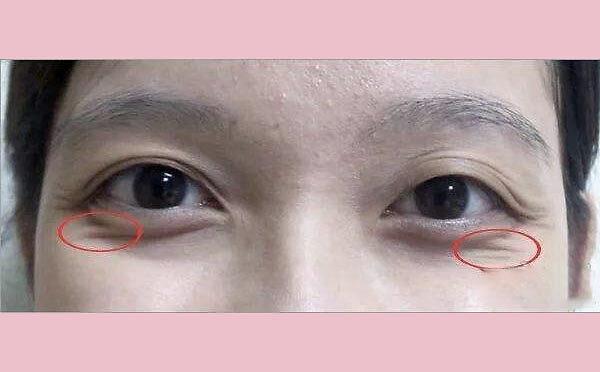 笑起来鱼尾纹很深的人易犯桃花劫吗