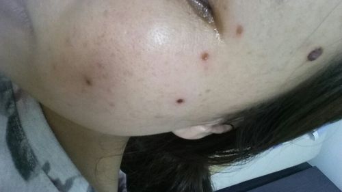 脸上的痦子可以随便点掉吗