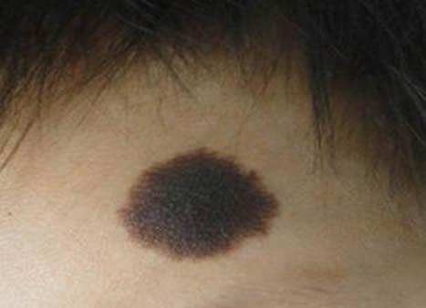 最有福气的9处胎记长在哪里