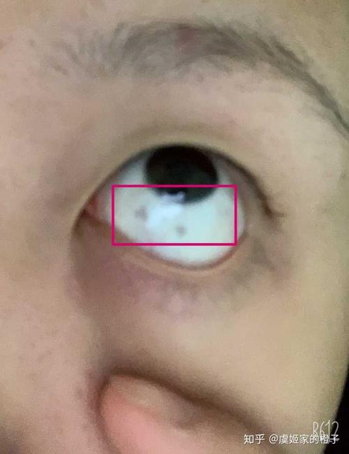 眼睛上有胎记的男人命运如何,有什么说法?