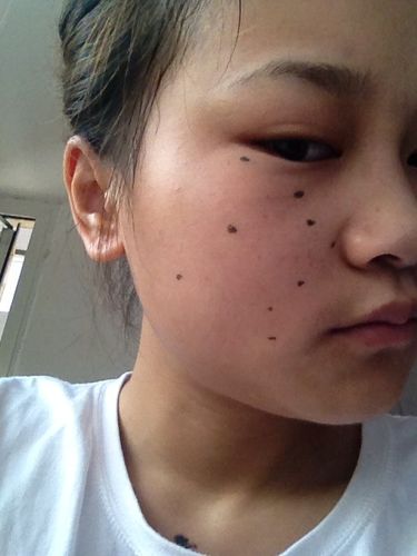 脸上的痦子能去掉吗