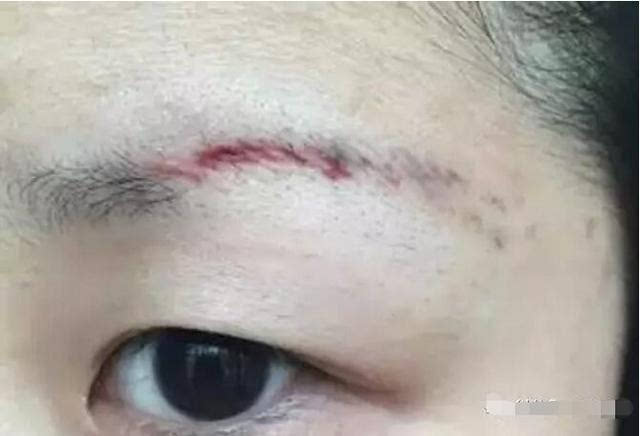眉毛有疤是命太好了吗