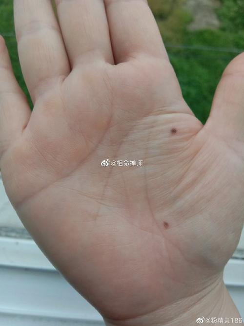 金星丘有痣