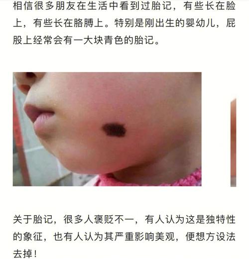 天生的胎记能不能去除
