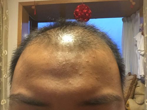 印堂有凸起的天柱骨