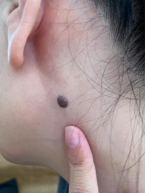 脖子附近的痣代表什么