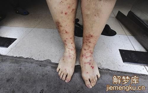梦见被虫咬是什么意思