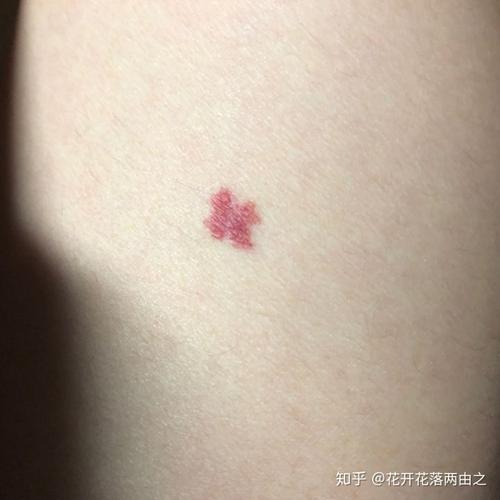 胎记长在哪些地方容易烂桃花