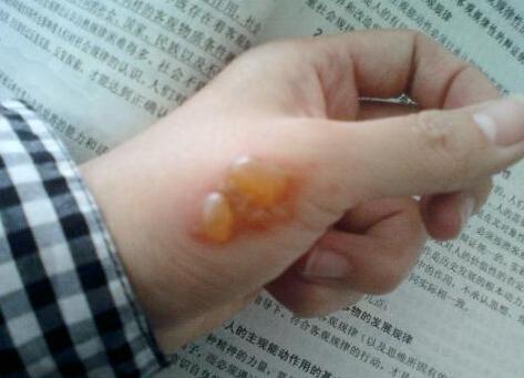 梦见手指起泡